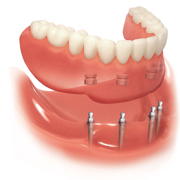 denture stabilization